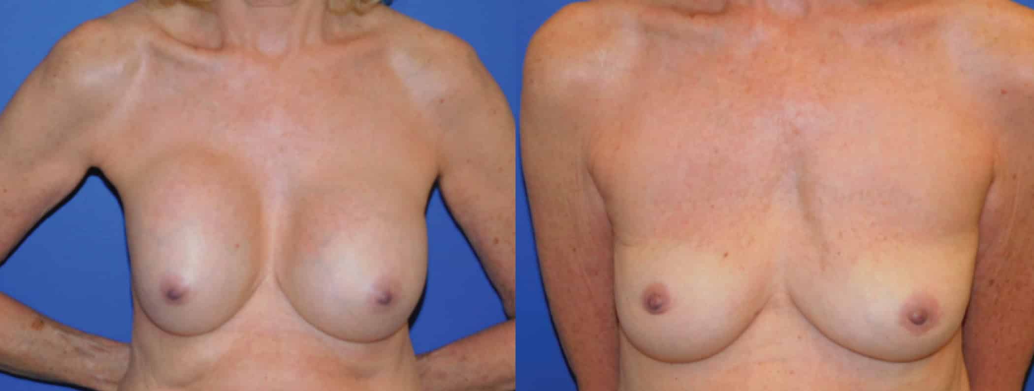 Before and After Image: Explantation / En Bloc Capsulectomy - front