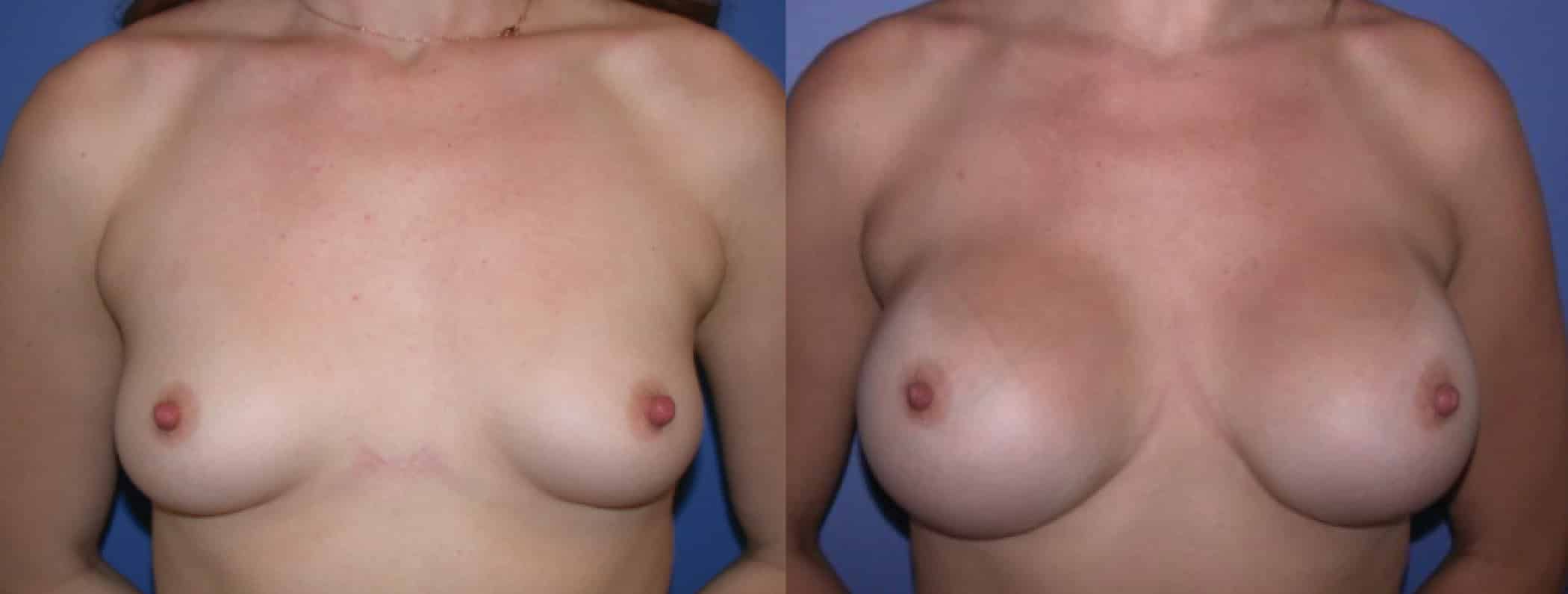 Before and After Image: Gummy Bear Implant - front