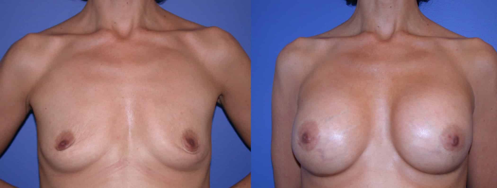 Before and After Image: Gummy Bear Implant - front
