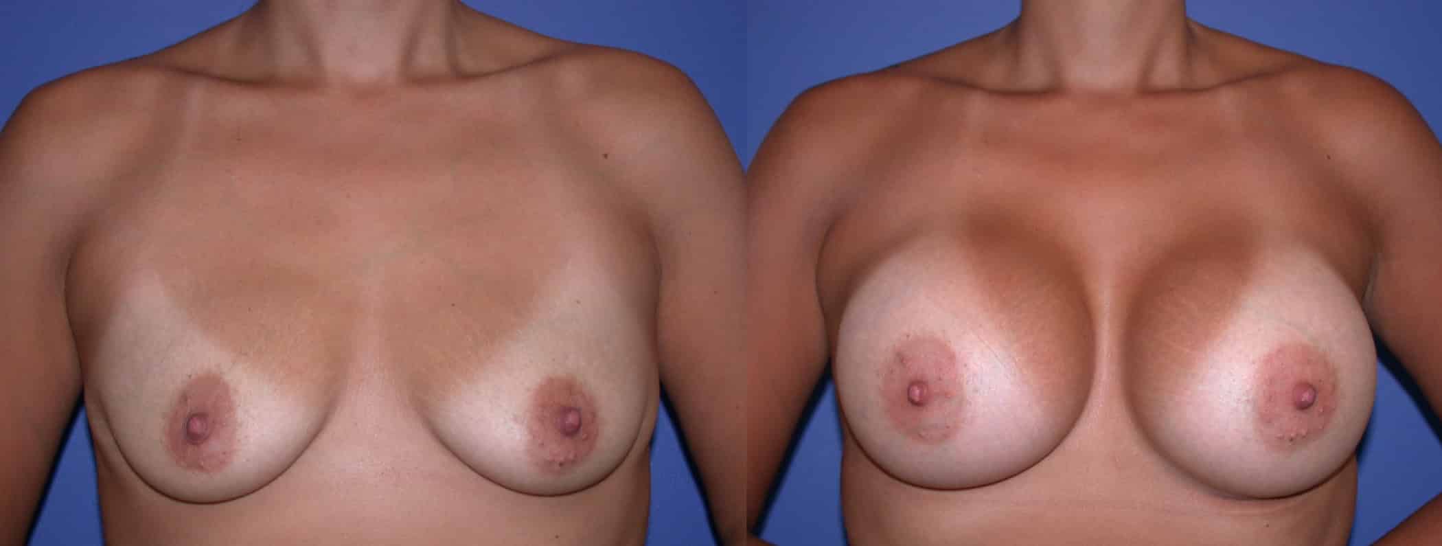 Before and After Image: Gummy Bear Implant - front