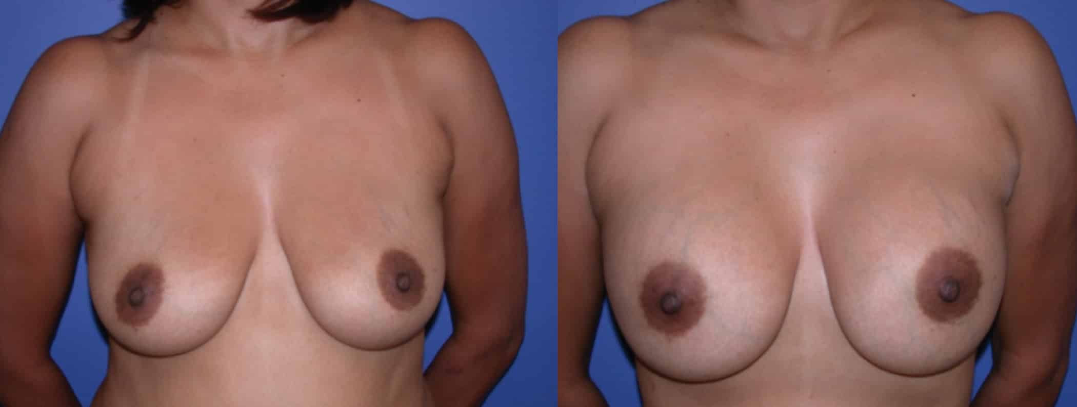 Before and After Image: Gummy Bear Implant - front