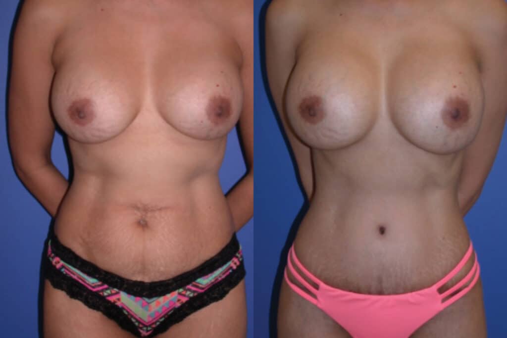Before and After Image: Liposuction - front