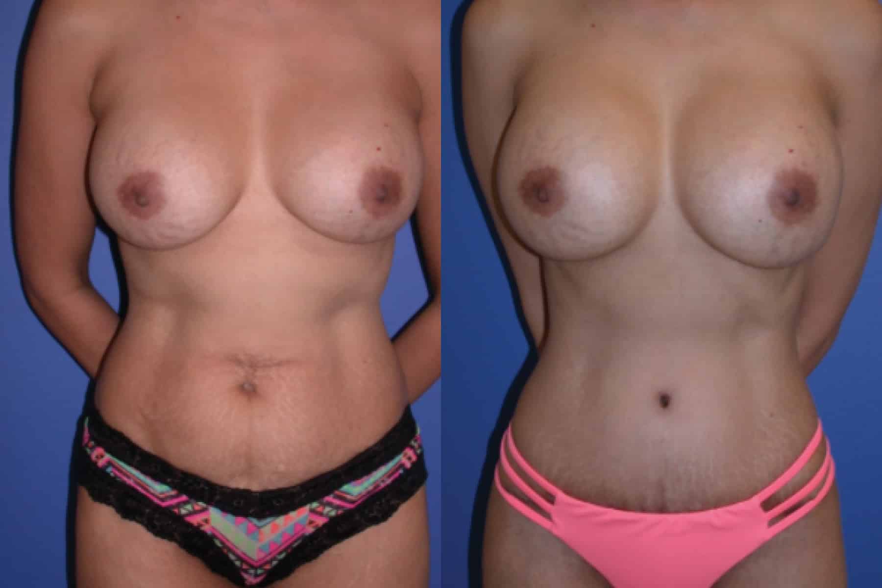 Before and After Image: Liposuction - front