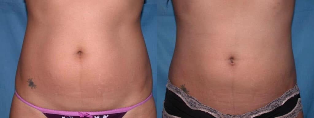 Before and After Image: Liposuction - front