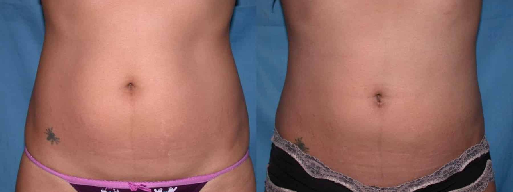 Before and After Image: Liposuction - front