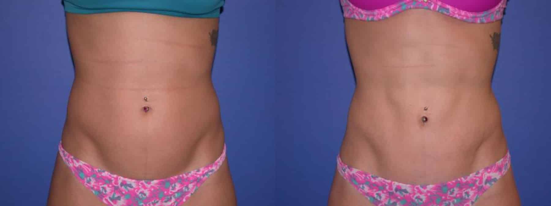 Before and After Image: Liposuction - front