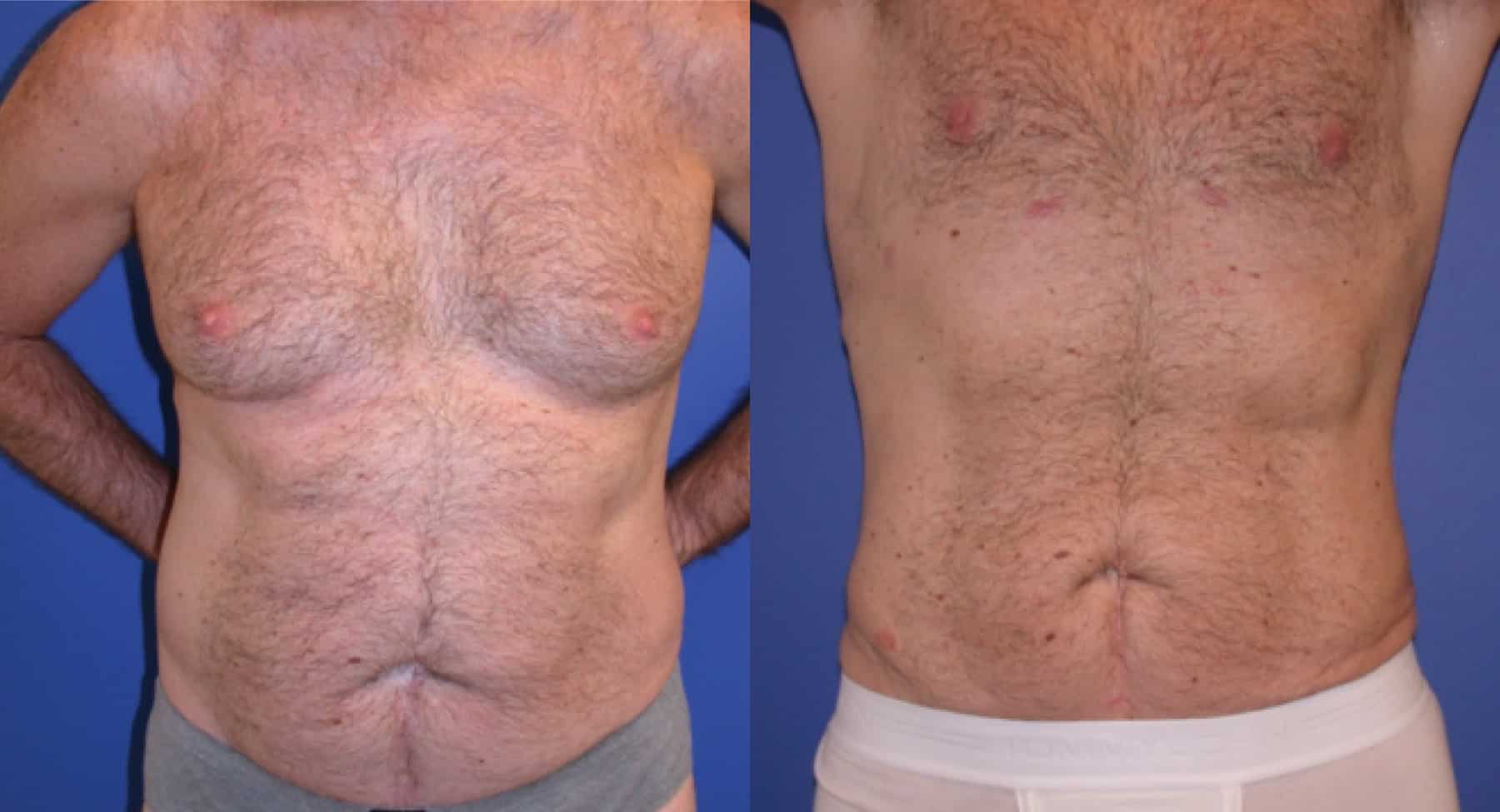 Before and After Image: Liposuction - front
