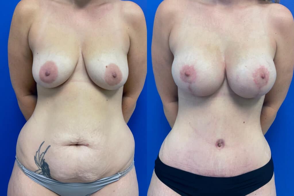 Before and After Image: Mommy Makeover - front