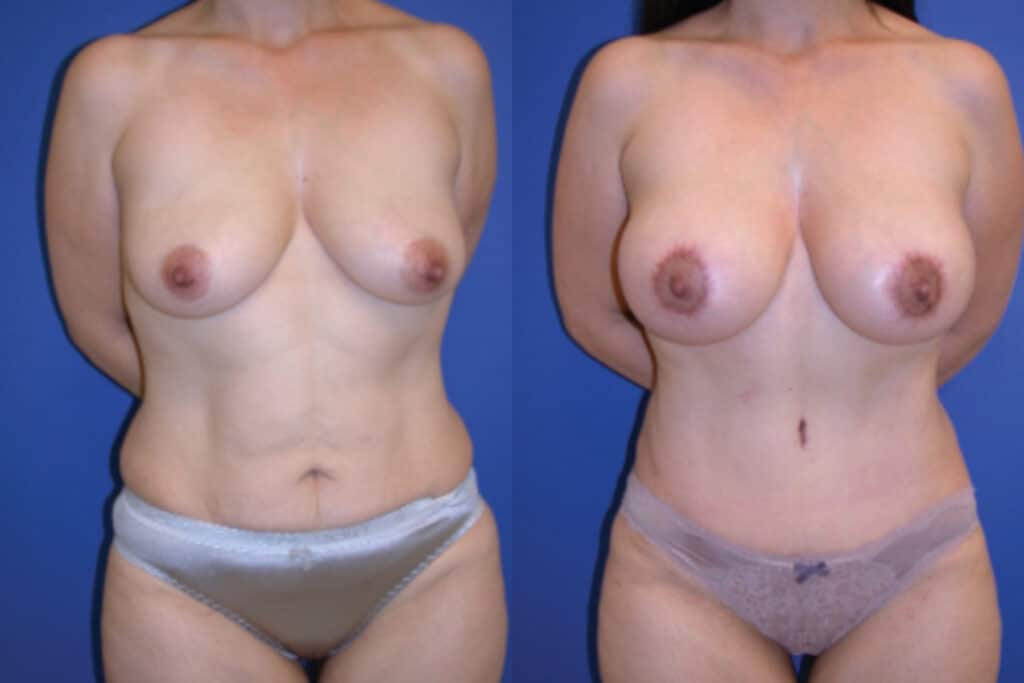 Before and After Image: Mommy Makeover - front