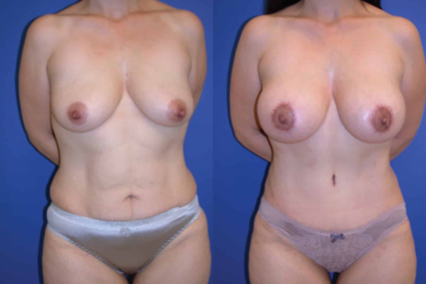Before and After Image: Mommy Makeover - front