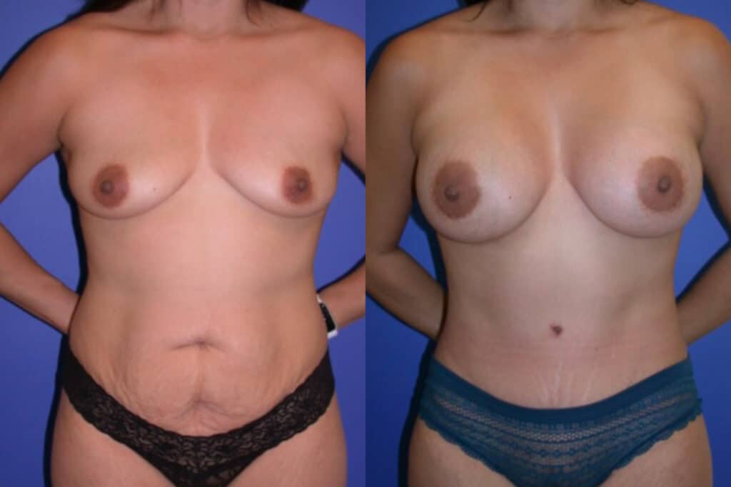 Before and After Image: Mommy Makeover - front