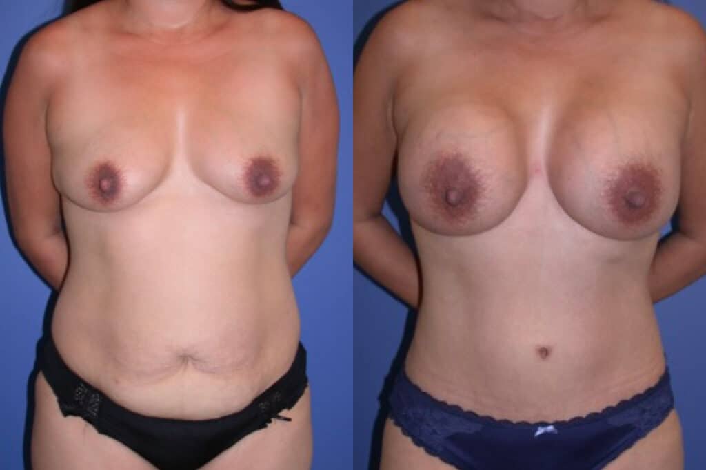 Before and After Image: Mommy Makeover - front