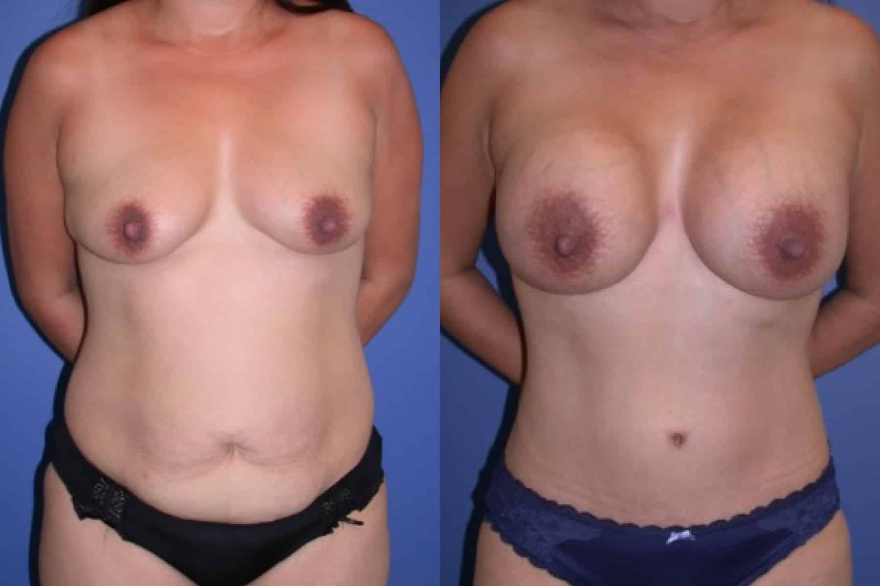 Before and After Image: Mommy Makeover - front