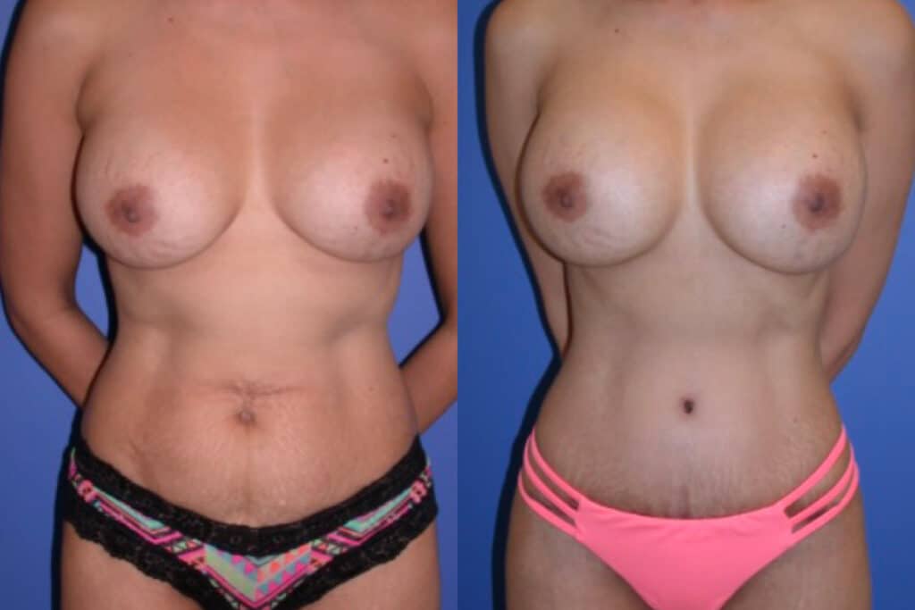 Before and After Image: Mommy Makeover - front