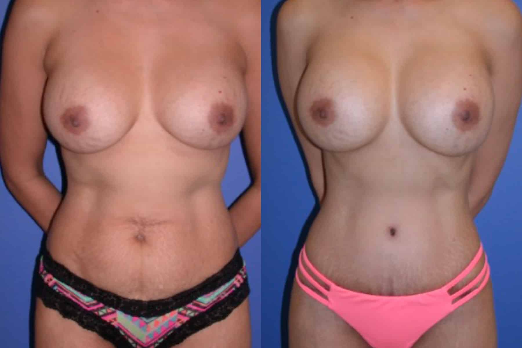 Before and After Image: Mommy Makeover - front