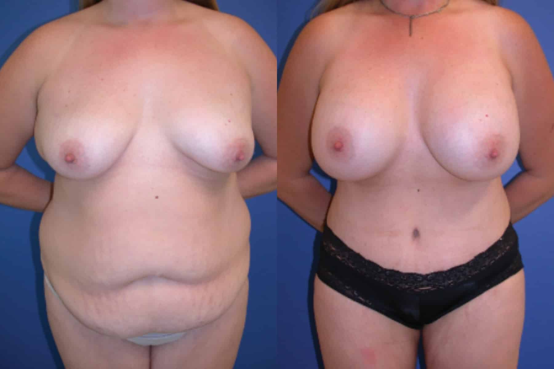 Before and After Image: Mommy Makeover - front