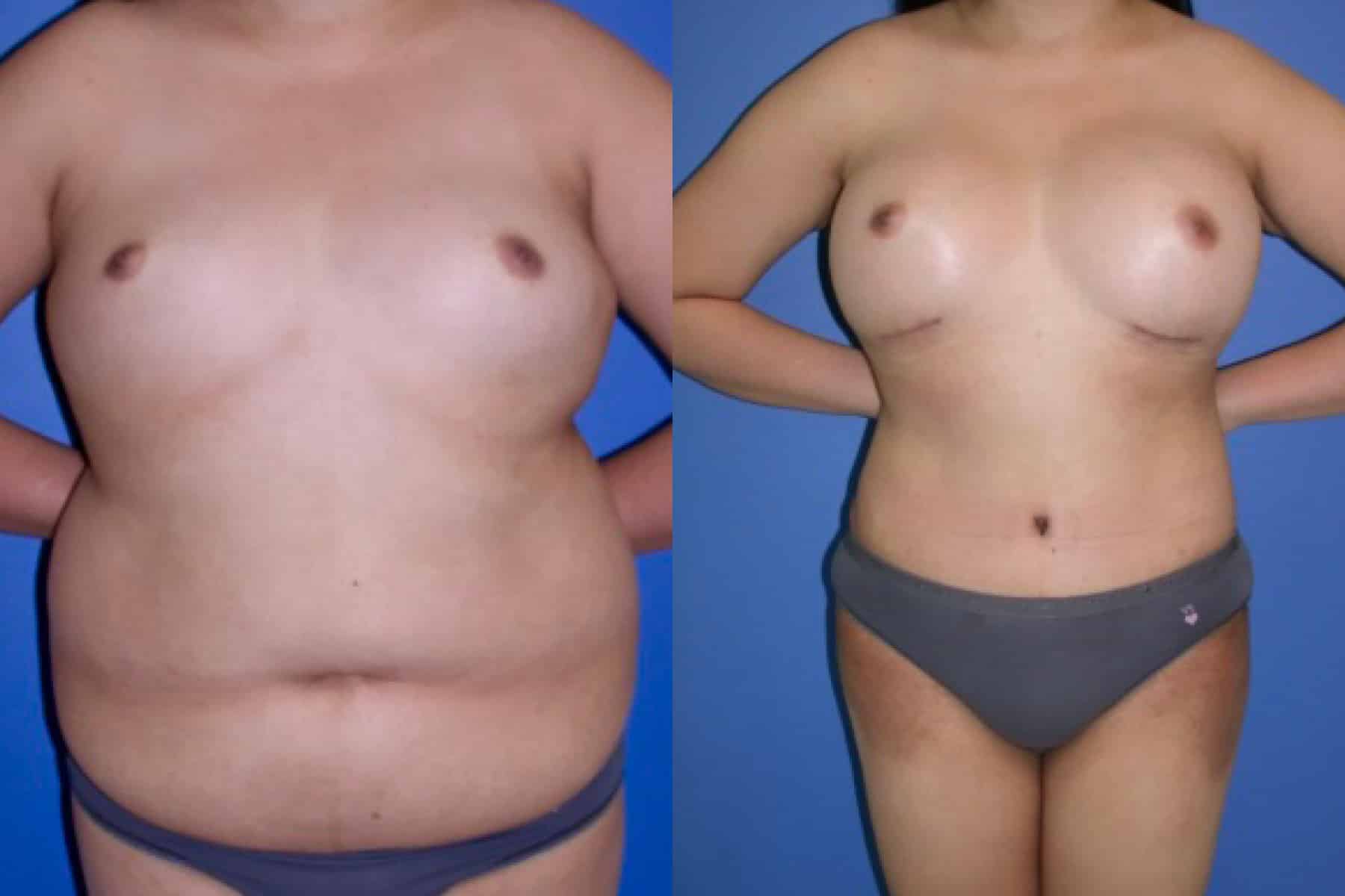 Before and After Image: Mommy Makeover - front