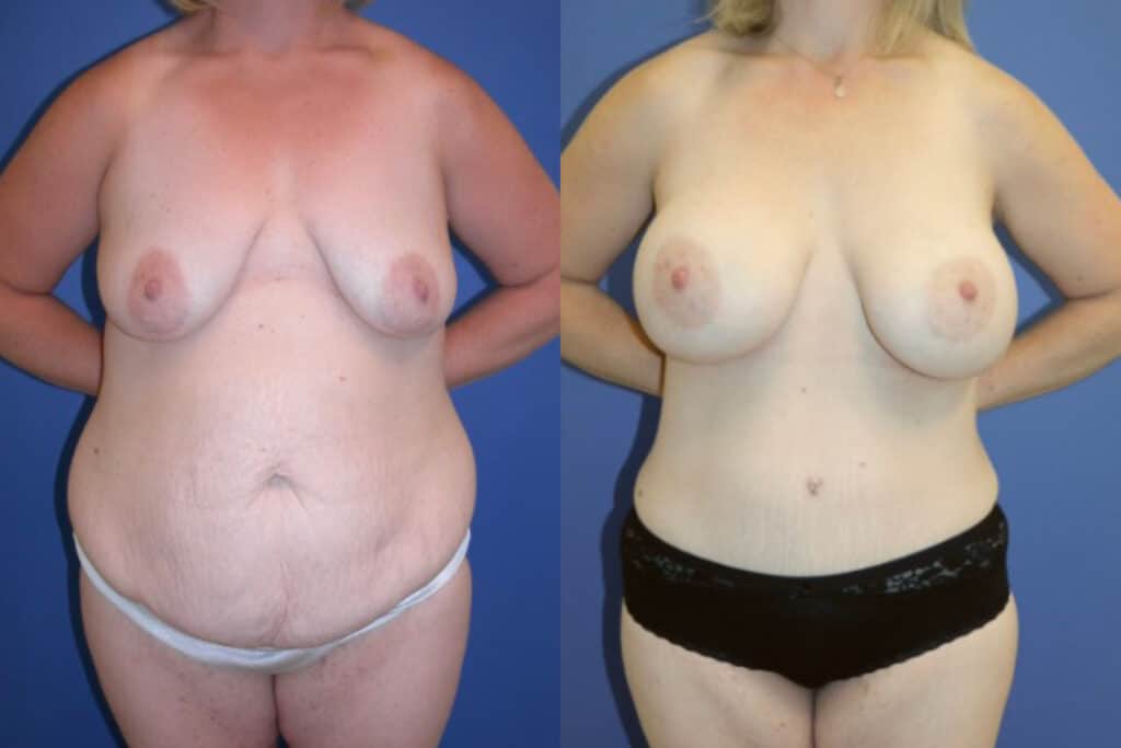 Before and After Image: Mommy Makeover - front