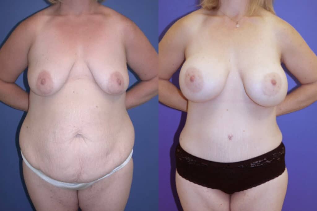 Before and After Image: Mommy Makeover - front