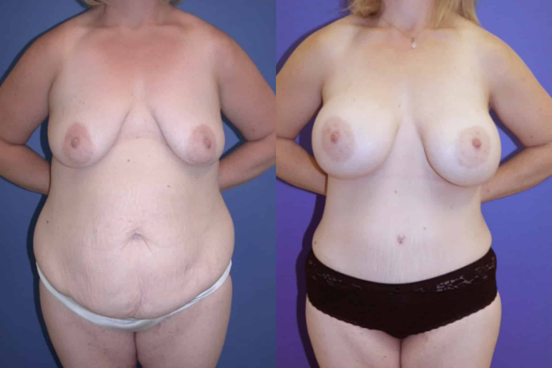 Before and After Image: Mommy Makeover - front