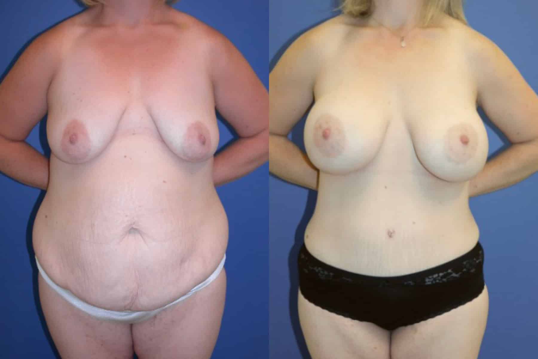 Before and After Image: Mommy Makeover - front