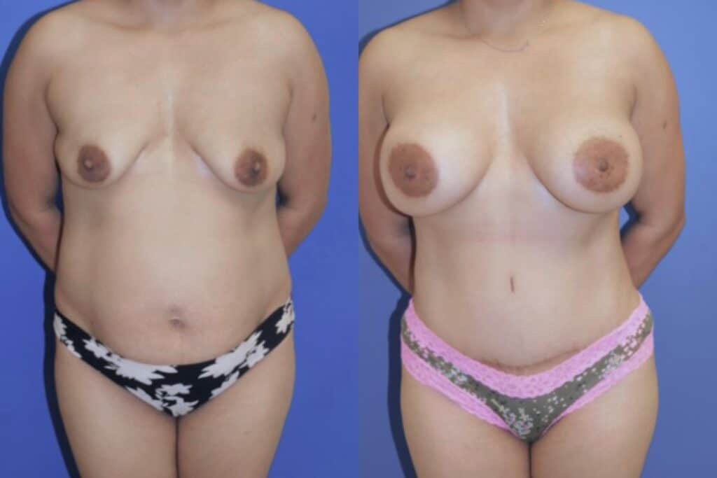 Before and After Image: Mommy Makeover - front