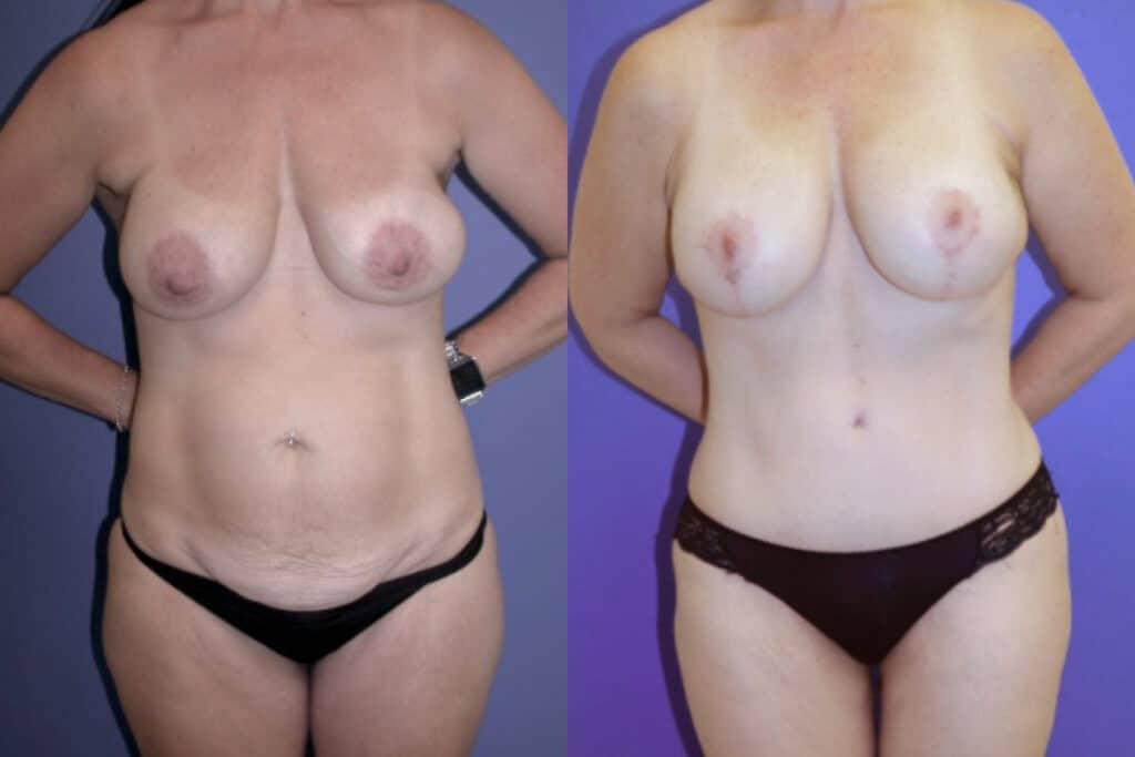 Before and After Image: Mommy Makeover - front