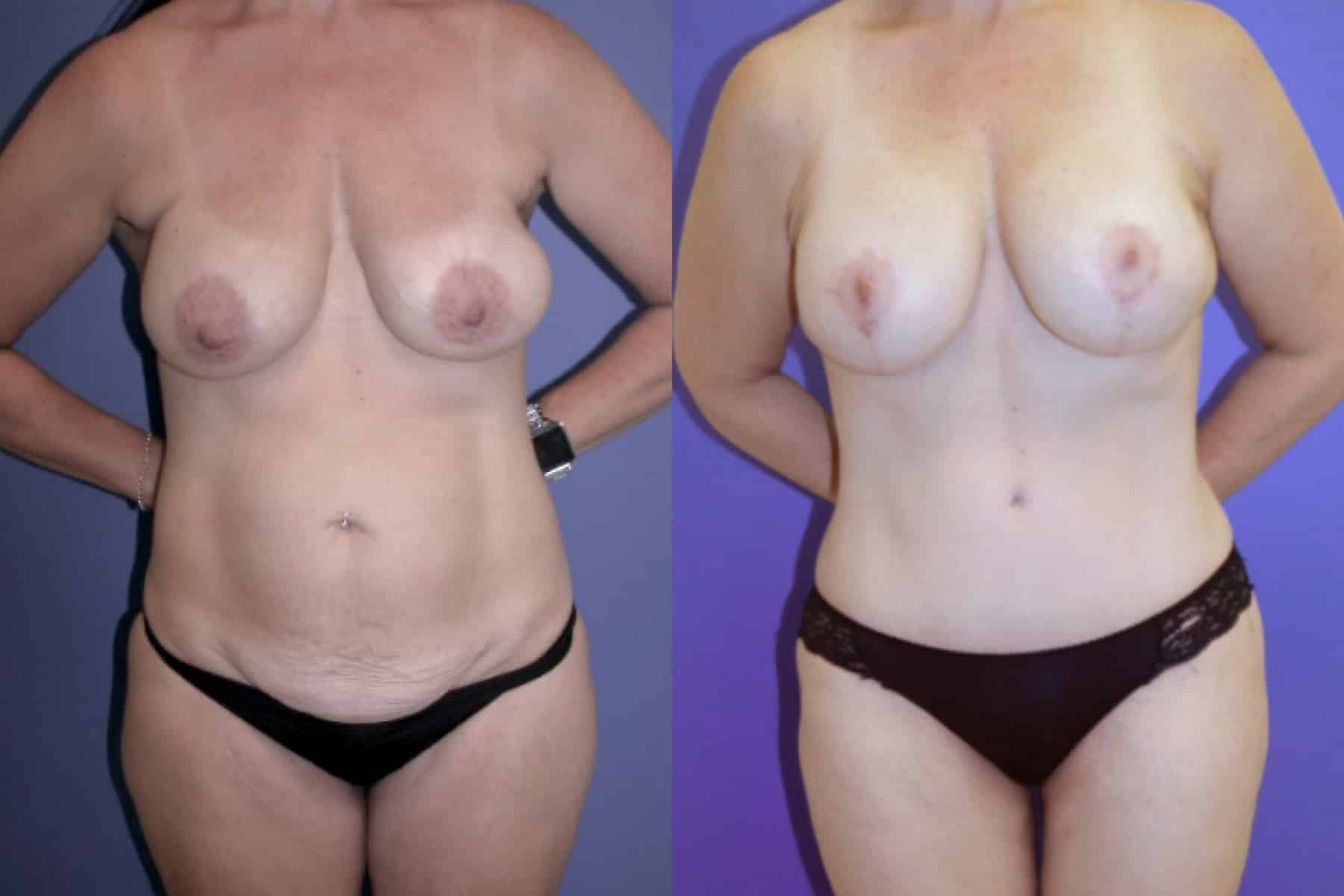 Before and After Image: Mommy Makeover - front