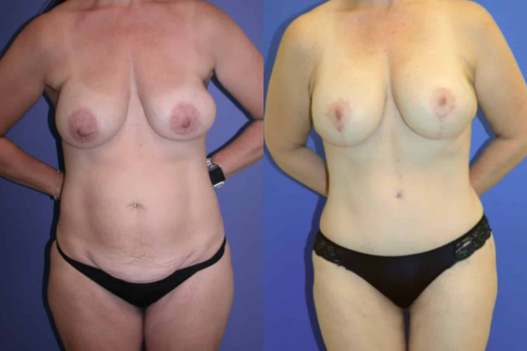 Before and After Image: Mommy Makeover - front