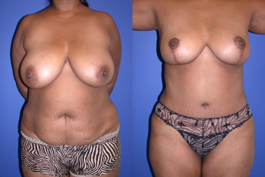 Before and After Image: Mommy Makeover - front