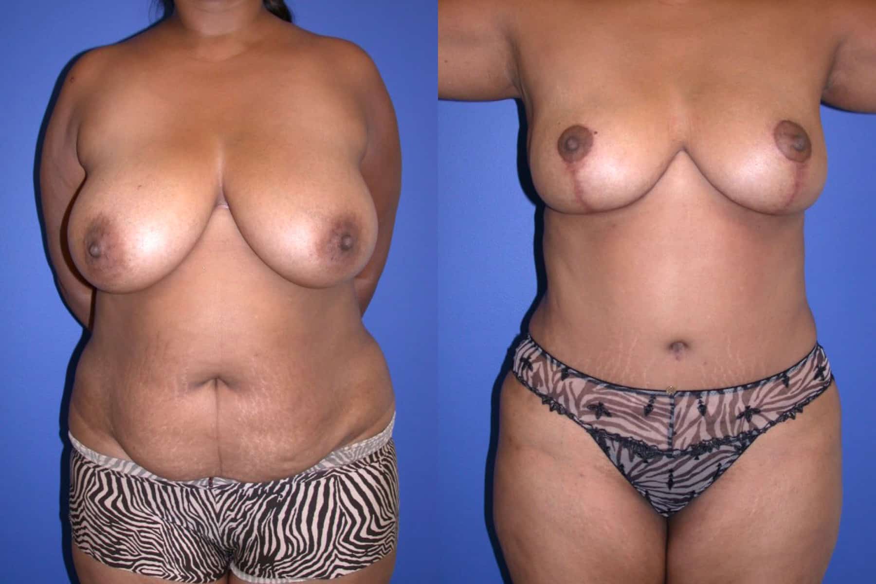 Before and After Image: Mommy Makeover - front
