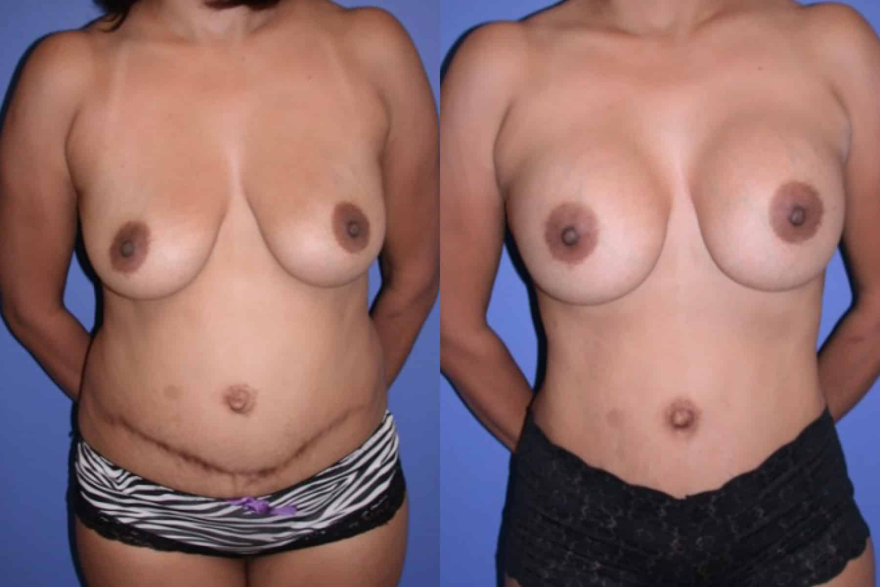 Before and After Image: Mommy Makeover - front