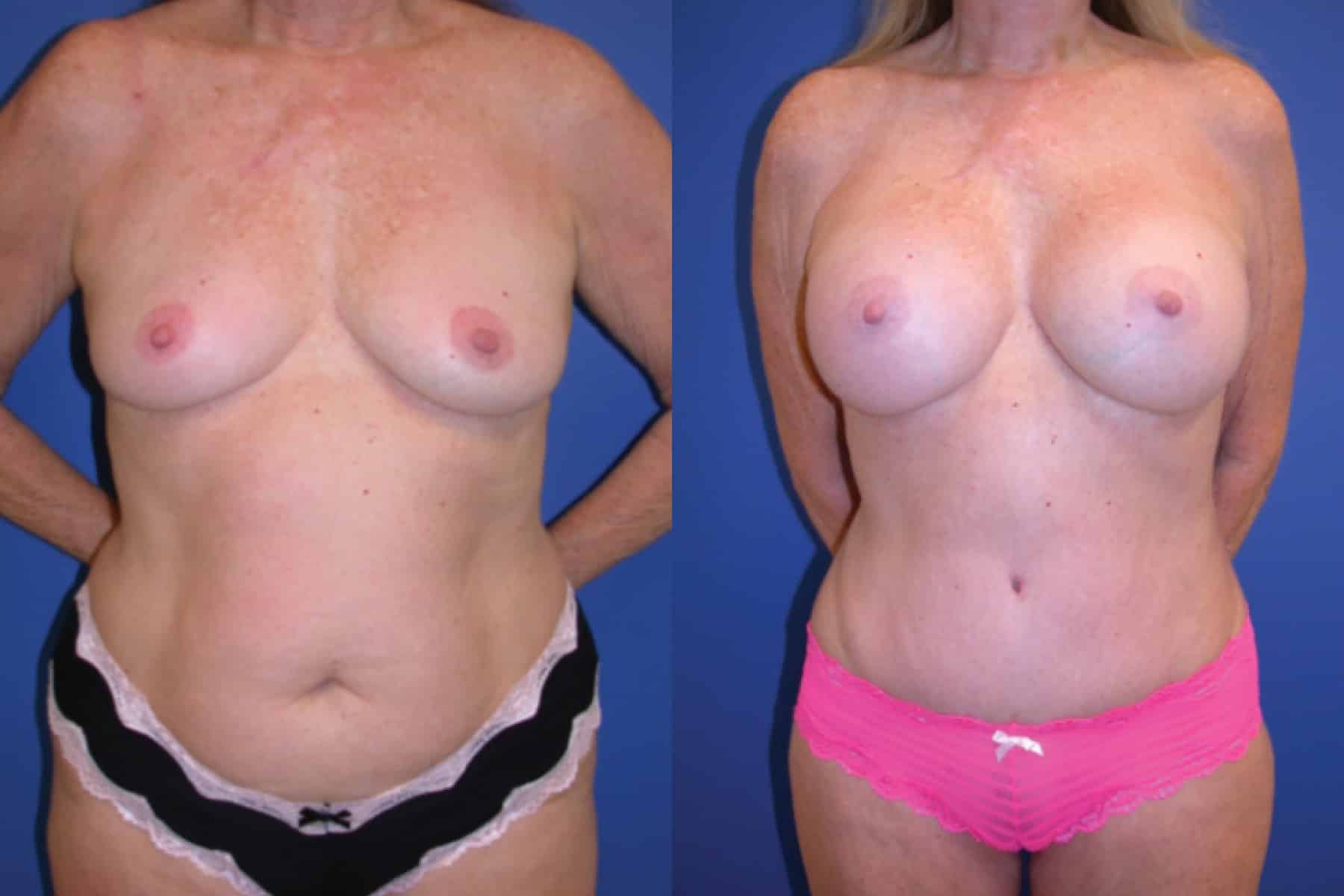 Before and After Image: Mommy Makeover - front