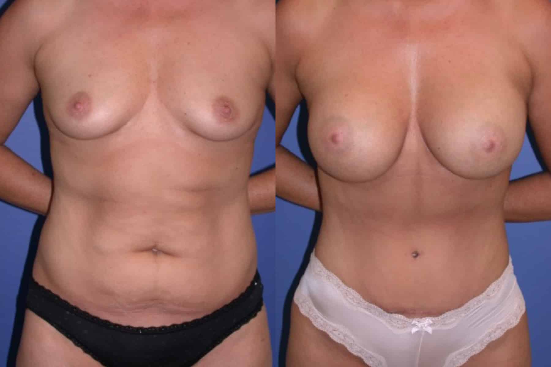 Before and After Image: Mommy Makeover - front