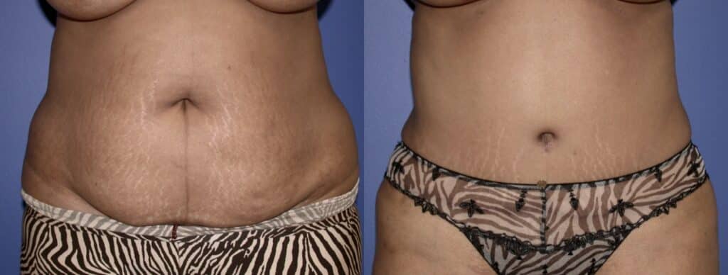Before and After Image: Tummy Tuck - front