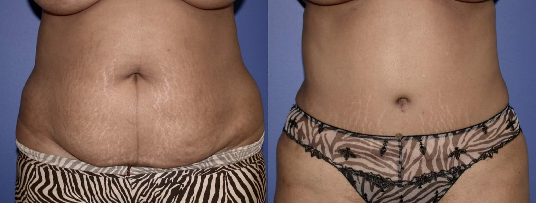 Before and After Image: Tummy Tuck - front