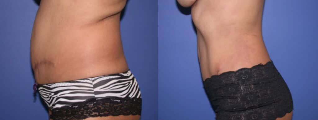 Before and After Image: Tummy Tuck - left-side