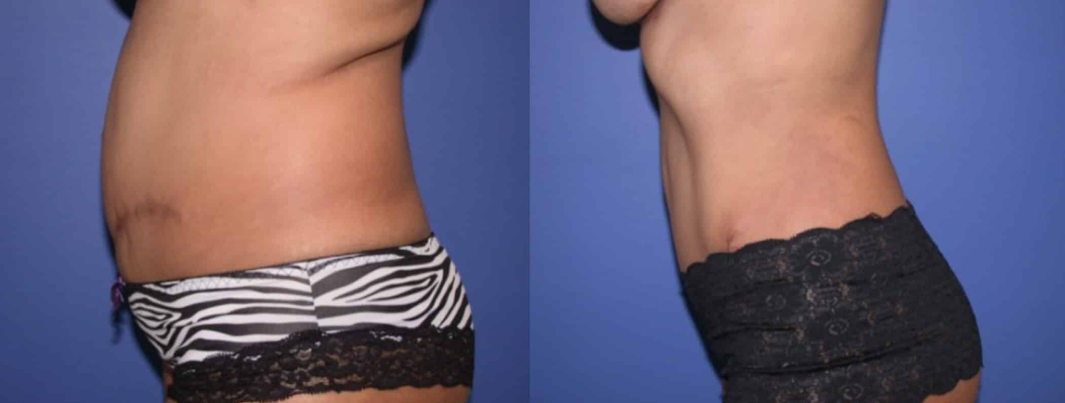 Before and After Image: Tummy Tuck - left-side