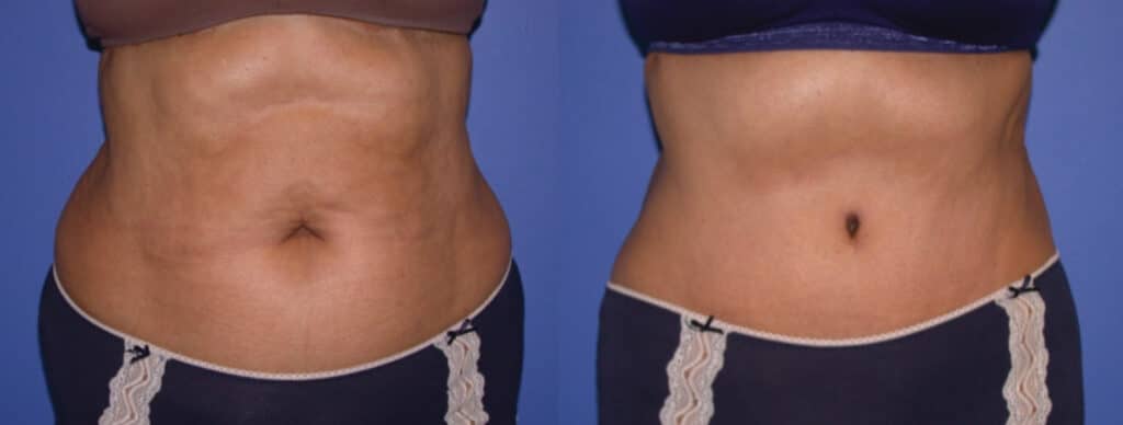 Before and After Image: Tummy Tuck - front
