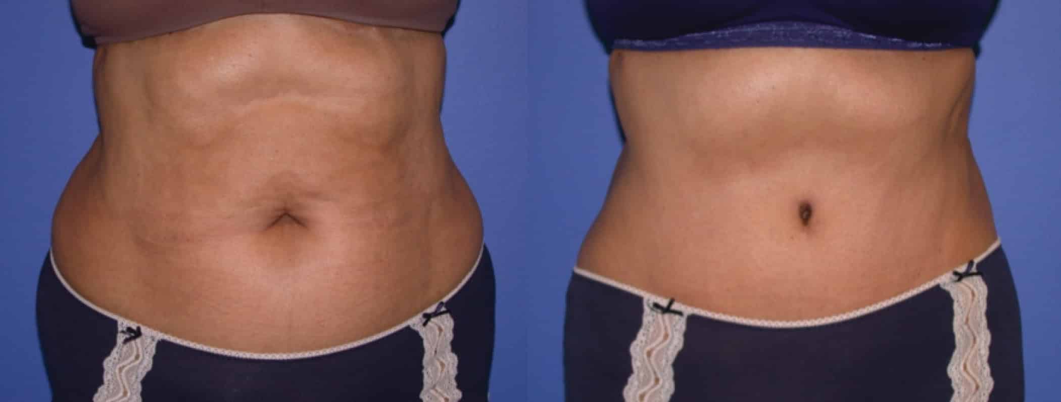 Before and After Image: Tummy Tuck - front