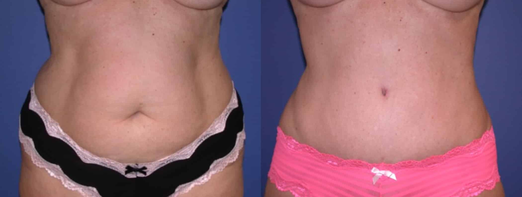 Before and After Image: Tummy Tuck - front