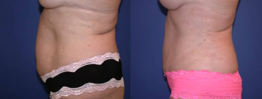 Before and After Image: Tummy Tuck - left-side