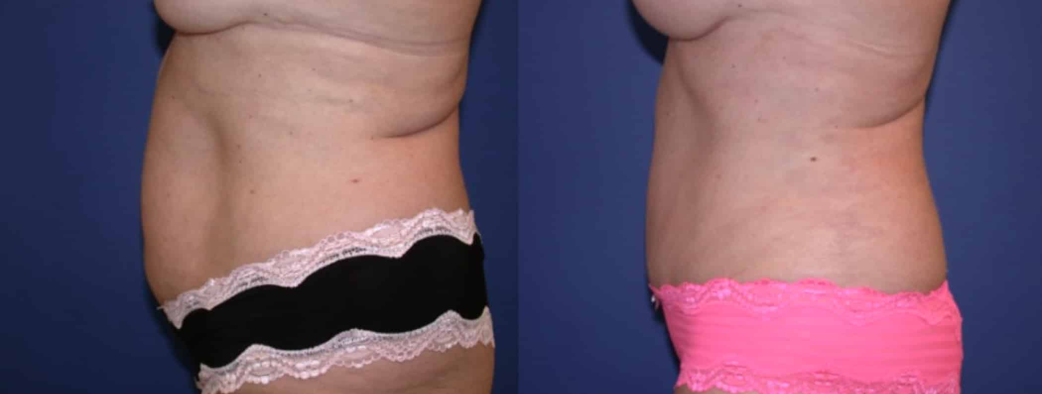Before and After Image: Tummy Tuck - left-side