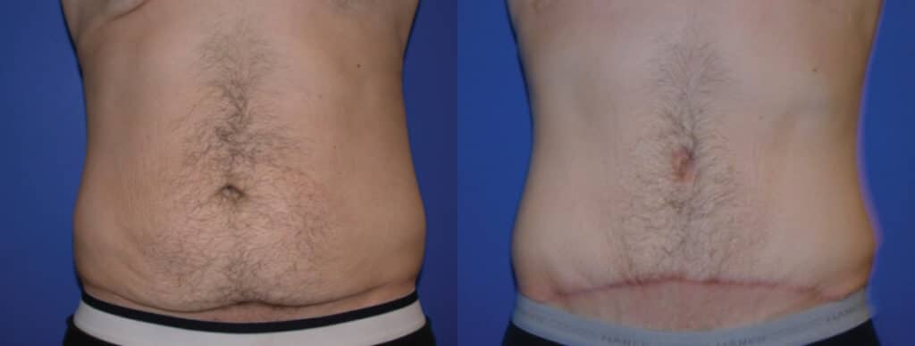 Before and After Image: Tummy Tuck - front
