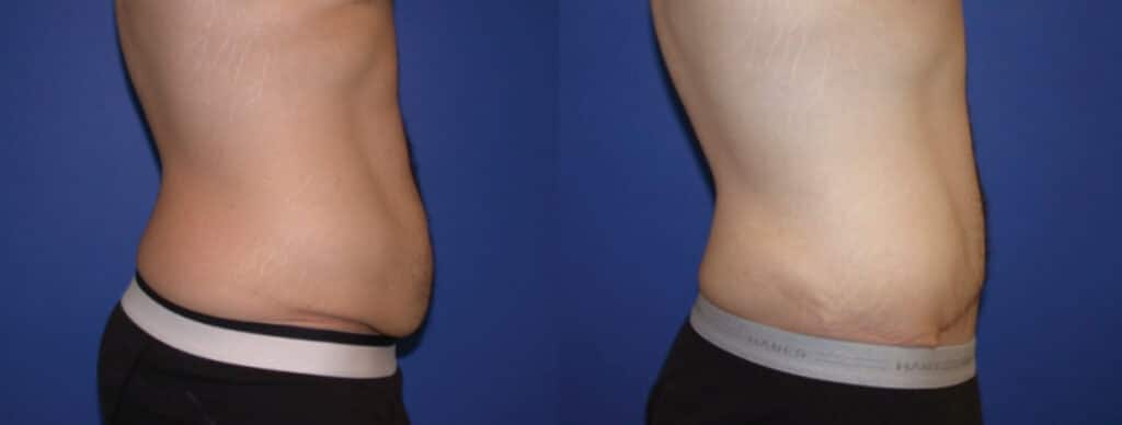 Before and After Image: Tummy Tuck - right-side