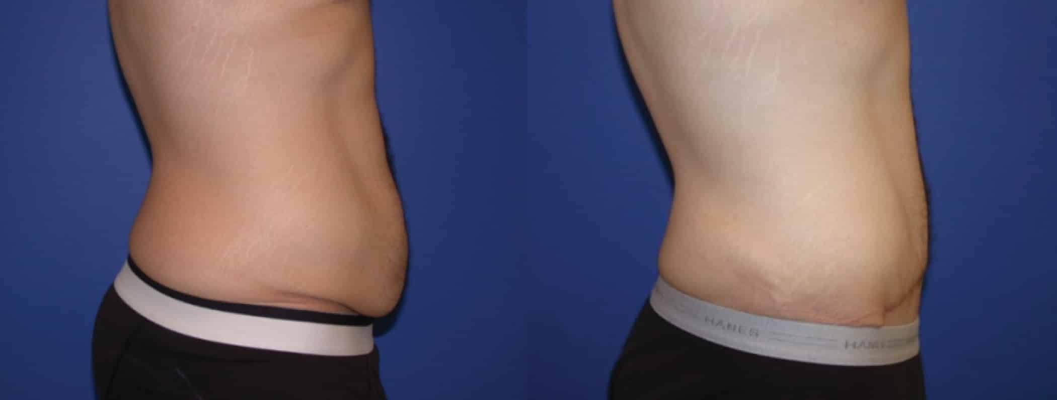 Before and After Image: Tummy Tuck - right-side