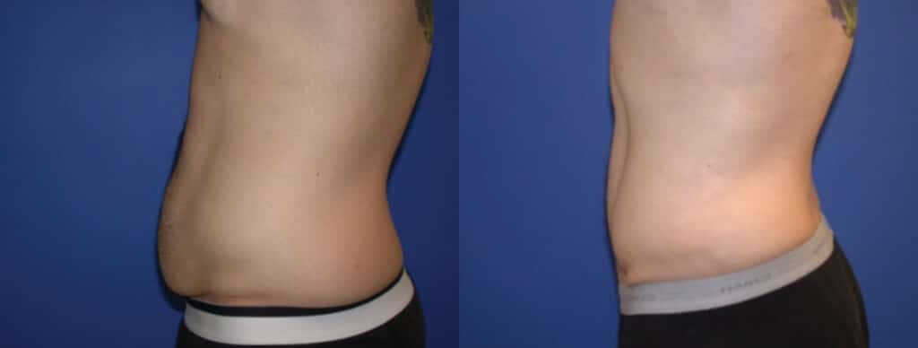 Before and After Image: Tummy Tuck - left-side