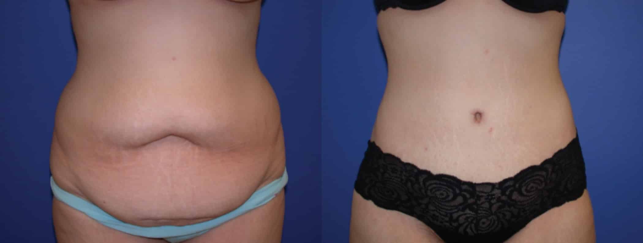 Before and After Image: Tummy Tuck - front