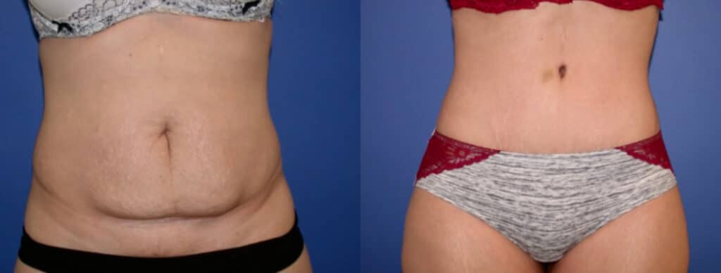 Before and After Image: Tummy Tuck - front
