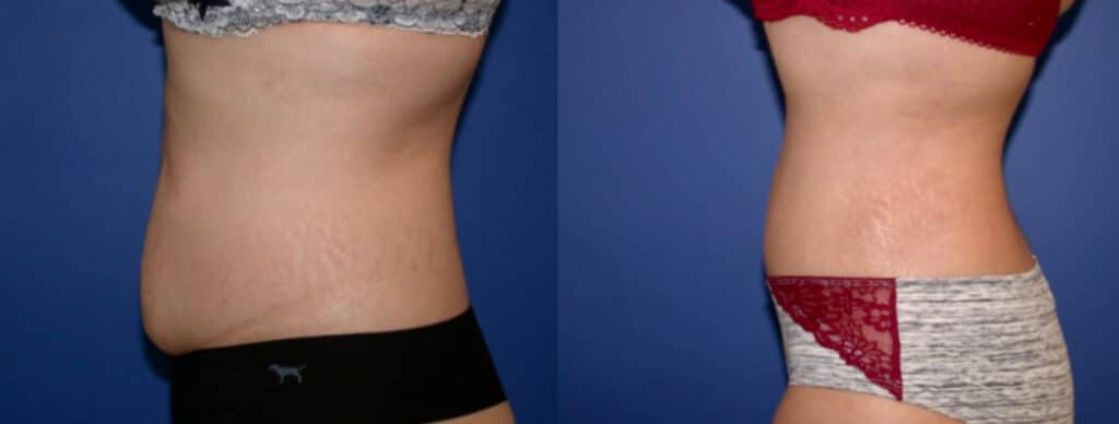 Before and After Image: Tummy Tuck - left-side